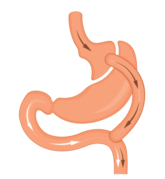 Gastric Bypass