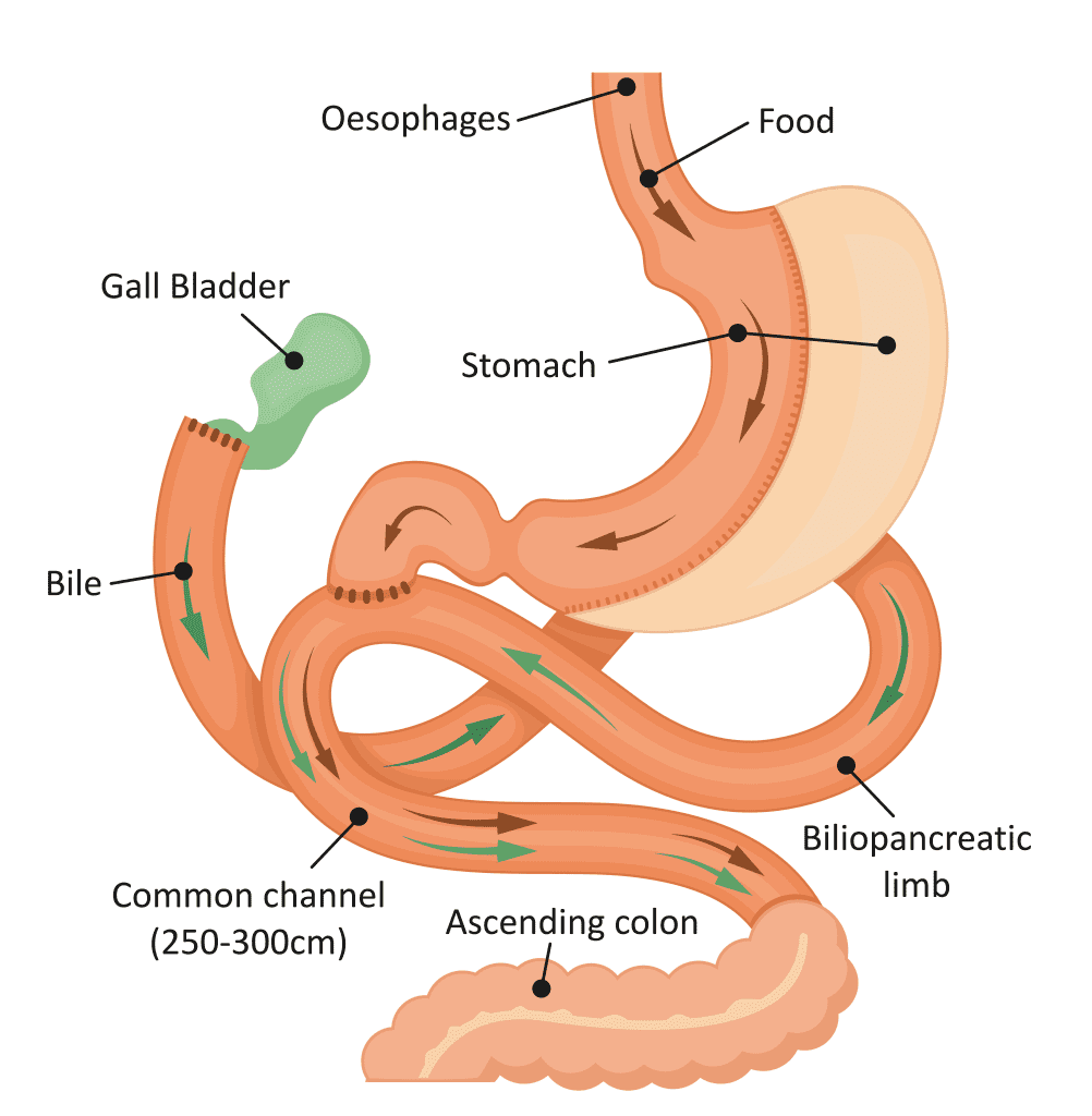 SADI-S Weight Loss Surgery in Cary — Bruce Wellness and Aesthetics