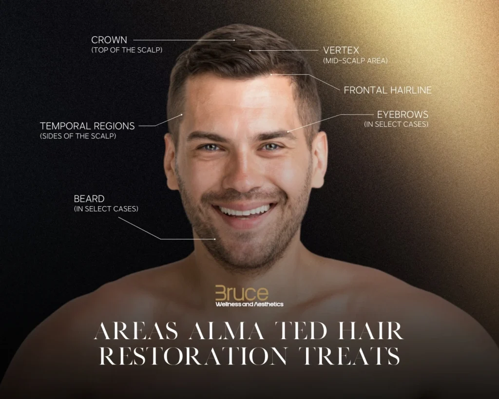 Areas Alma TED Hair Restoration Treats